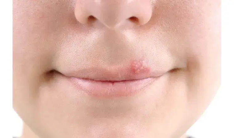 Επιχείλιος έρπης: Πώς να τον αντιμετωπίσετε πιο γρήγορα